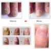 Nail Infections Treatment Serum
