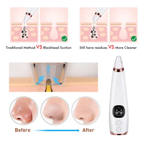 Ultra-Powerful Pore Vacuum Pro: Expert Blackhead Removal &Amp; Rejuvenation System